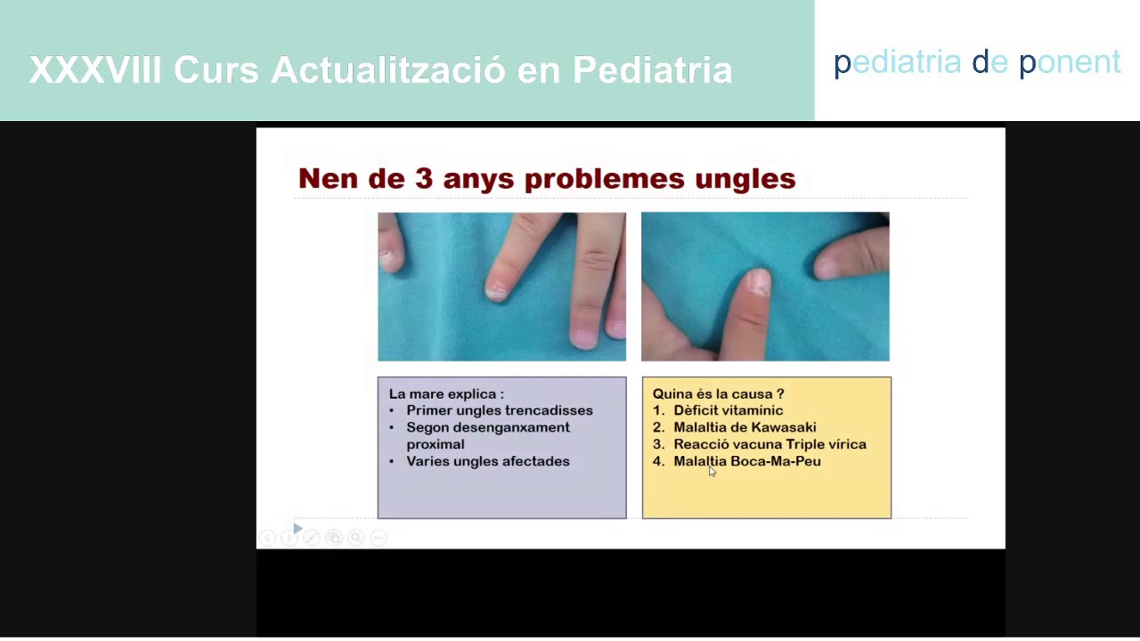 Alteracions unguials a pediatria de Pediatres de Ponent